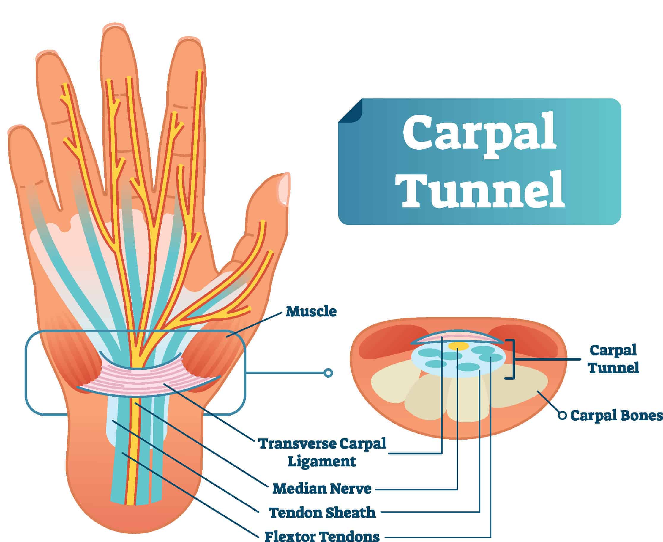 Medical diagram showing the wrist and the pathology of carpal tunnel