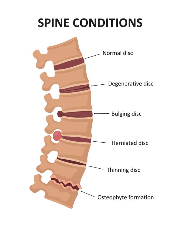 Illustration of the stages of spinal Degenerative Disc Disease a.k.a. Slip